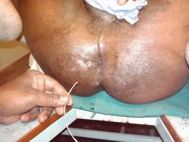 Figure 6: Method of Application of Threads. The tip of the probe is seen coming out of the anal orifice and has been threaded.