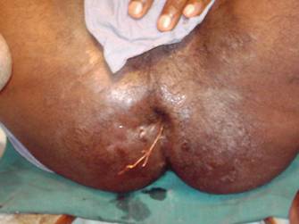 Figure 7: Method of Application of Threads. The thread is seen in the fistulous tract after withdrawl of probe.