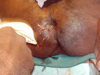 Figure 7: Method of Application of Threads. The thread is seen in the fistulous tract after withdrawl of probe.